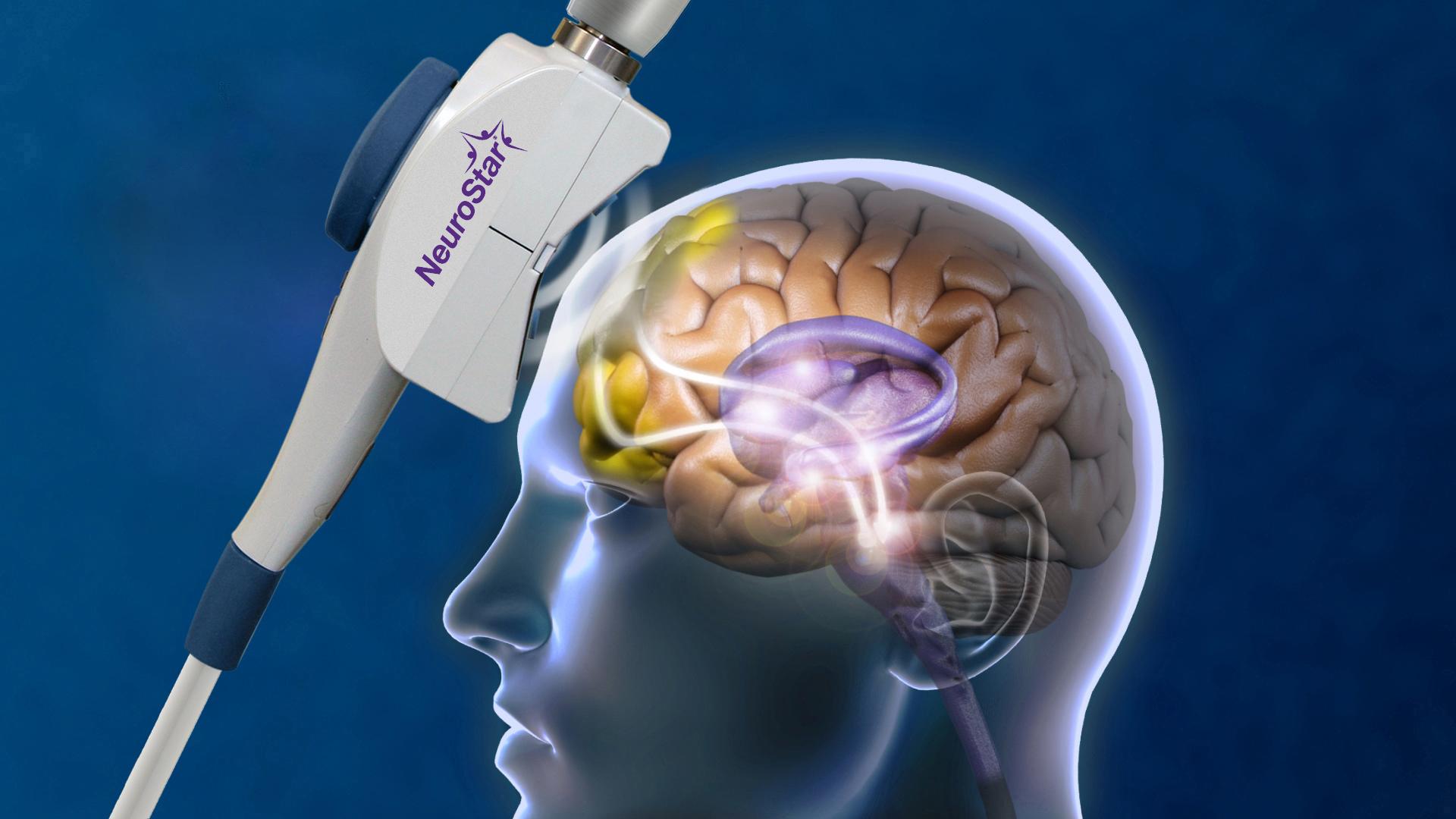 A NeuroStar head coil diagram showing treatment pathways and how it works within the human brain.